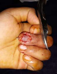 Figure 4 After repair of nail bed and fracture fixation