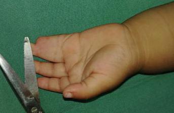 Figure 1 Syndactyly in 16 months old child