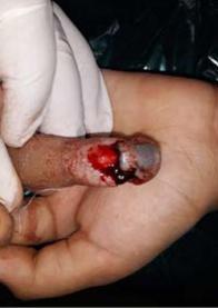 Figure 3 Fingertip injury in 5 yr old girl